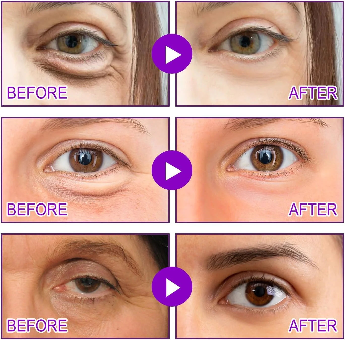 Say Goodbye to Embarrassing Under Eye Bags with MicroGlow