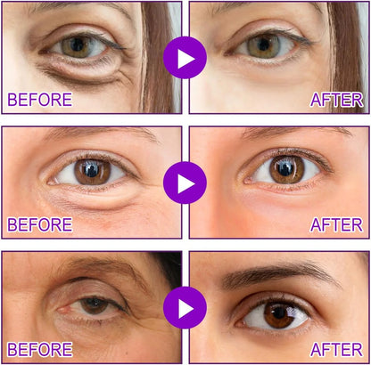 Say Goodbye to Embarrassing Under Eye Bags with MicroGlow